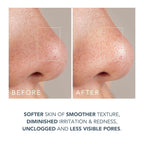 FOREO KIWI – Microdermabrasion & Blackhead Remover