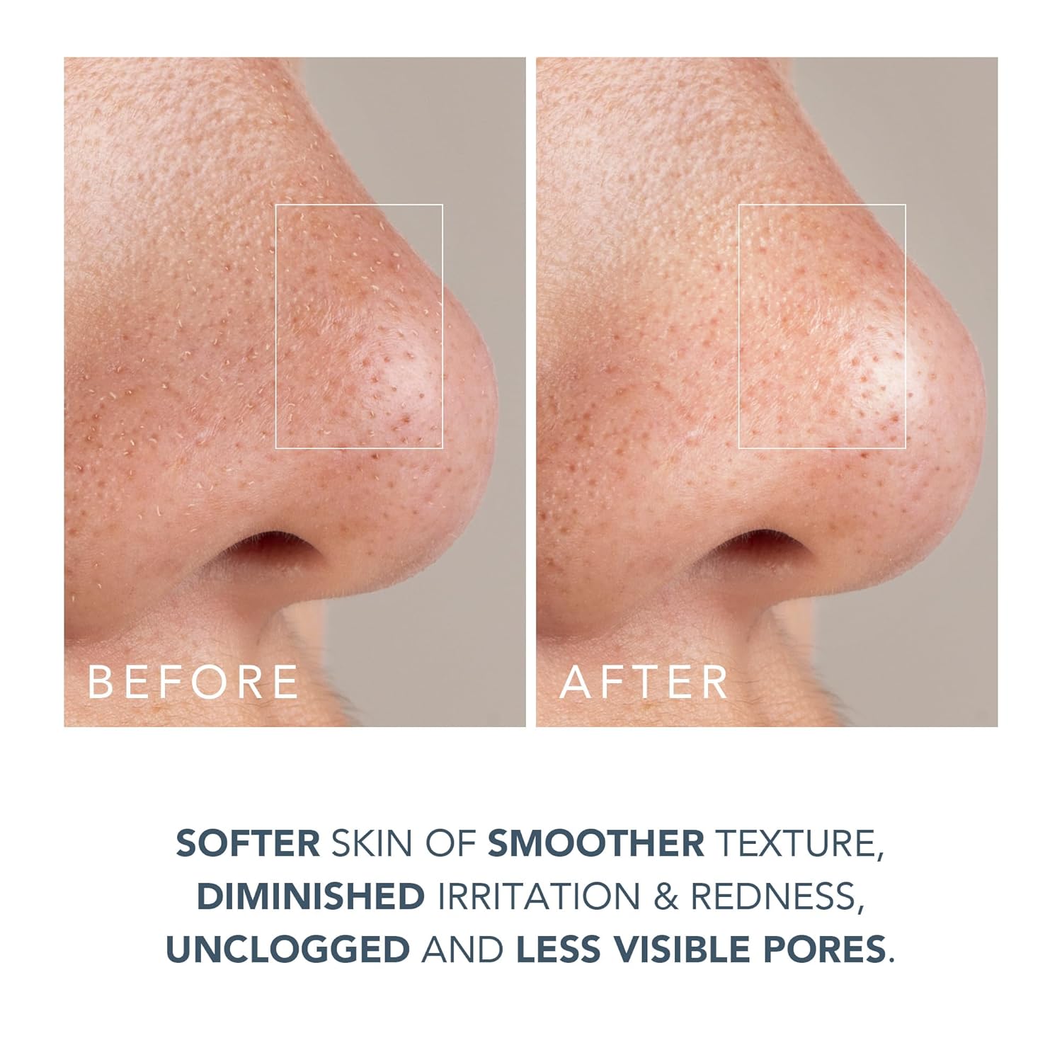 FOREO KIWI – Microdermabrasion & Blackhead Remover