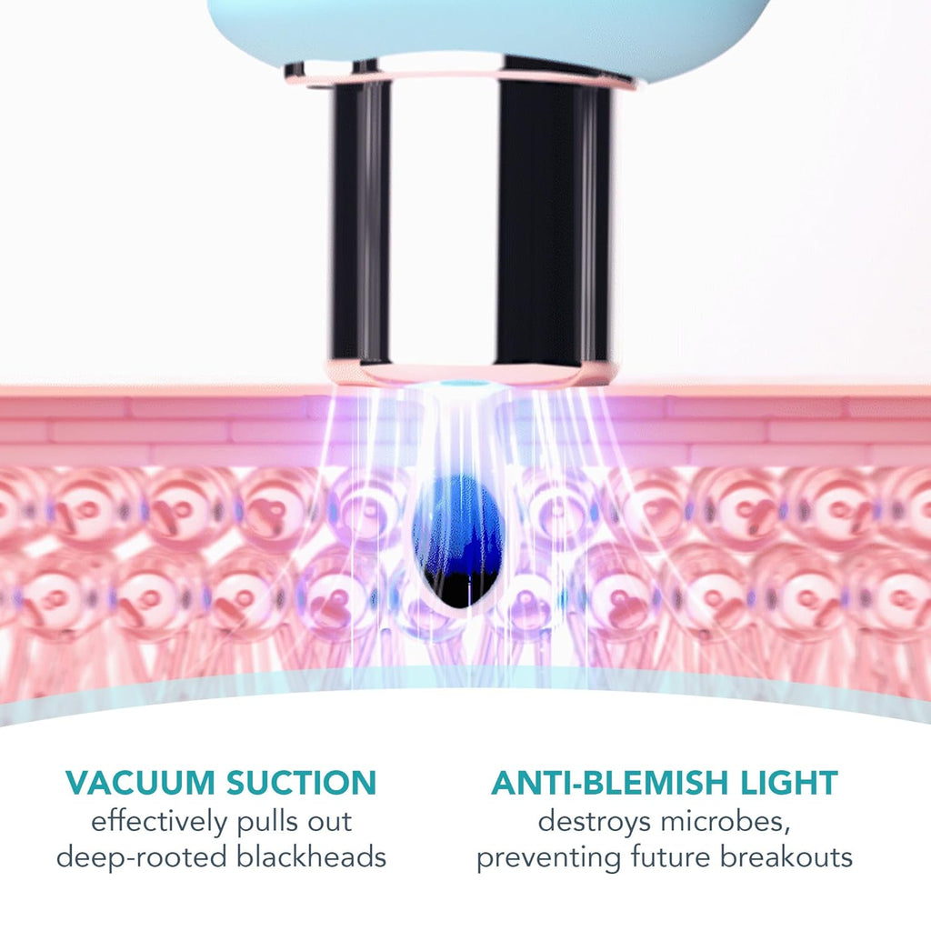 FOREO KIWI – Microdermabrasion & Blackhead Remover