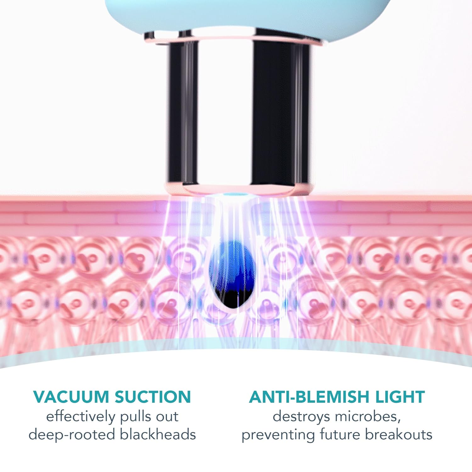 FOREO KIWI – Microdermabrasion & Blackhead Remover