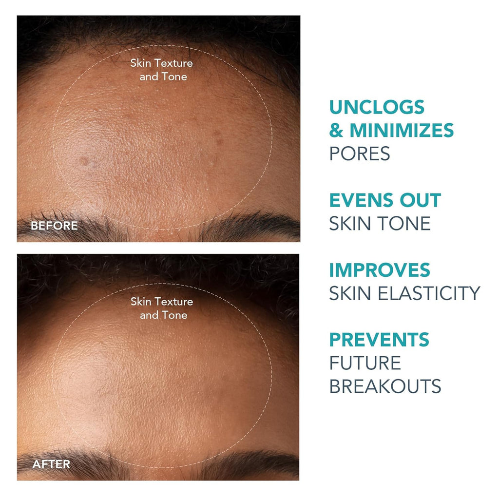 FOREO KIWI – Microdermabrasion & Blackhead Remover