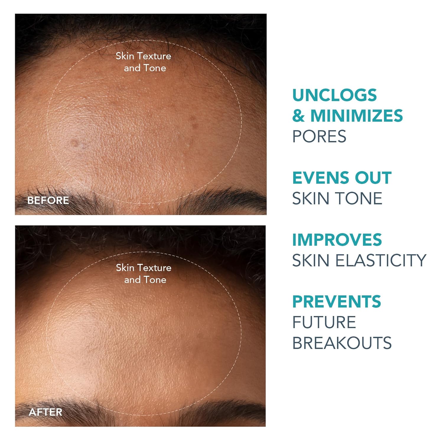 FOREO KIWI – Microdermabrasion & Blackhead Remover
